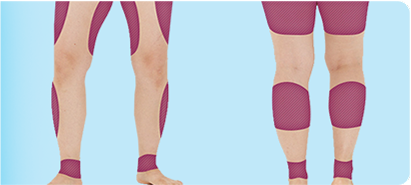 Photo showing thick legs slimming down after V-Logic Body PT injection