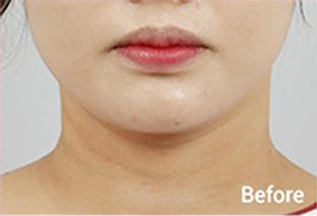 Before-and-after photo of V-line results after Contour Tox 4 types treatment