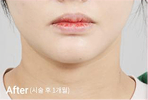 Before-and-after photo of V-line results after Contour Tox 4 types treatment