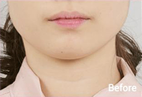 Before-and-after photo of V-line results after Contour Tox 4 types treatment