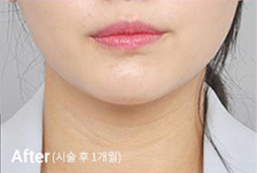 Before-and-after photo of V-line results after Contour Tox 4 types treatment