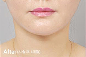 Before-and-after photo of V-line results after Contour Tox 4 types treatment