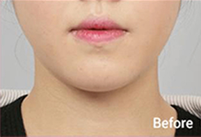 Before-and-after photo of V-line results after Contour Tox 4 types treatment