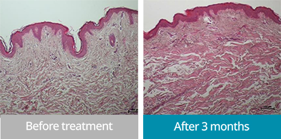 ONDA lifting before-and-after photos - skin lifting and elasticity improvement through collagen production