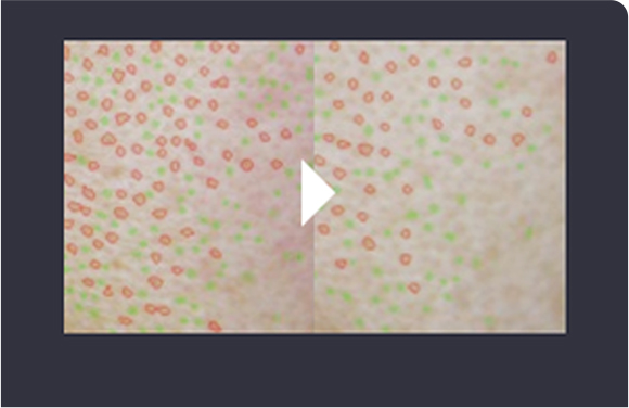 Pore size reduction comparison image 4 weeks after Rejuran Healer treatment