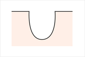 Various shapes of pores and scars - ice pick, rolling, boxcar