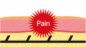 Explanation of how barbs fixed on threads in regular thread lifting stimulate nerves causing pain
